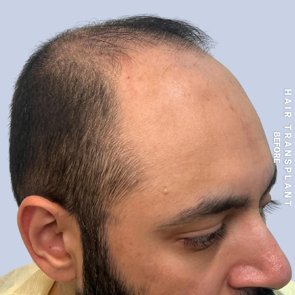 Hair Restoration Before & After Gallery - Patient 130289 - Image 5