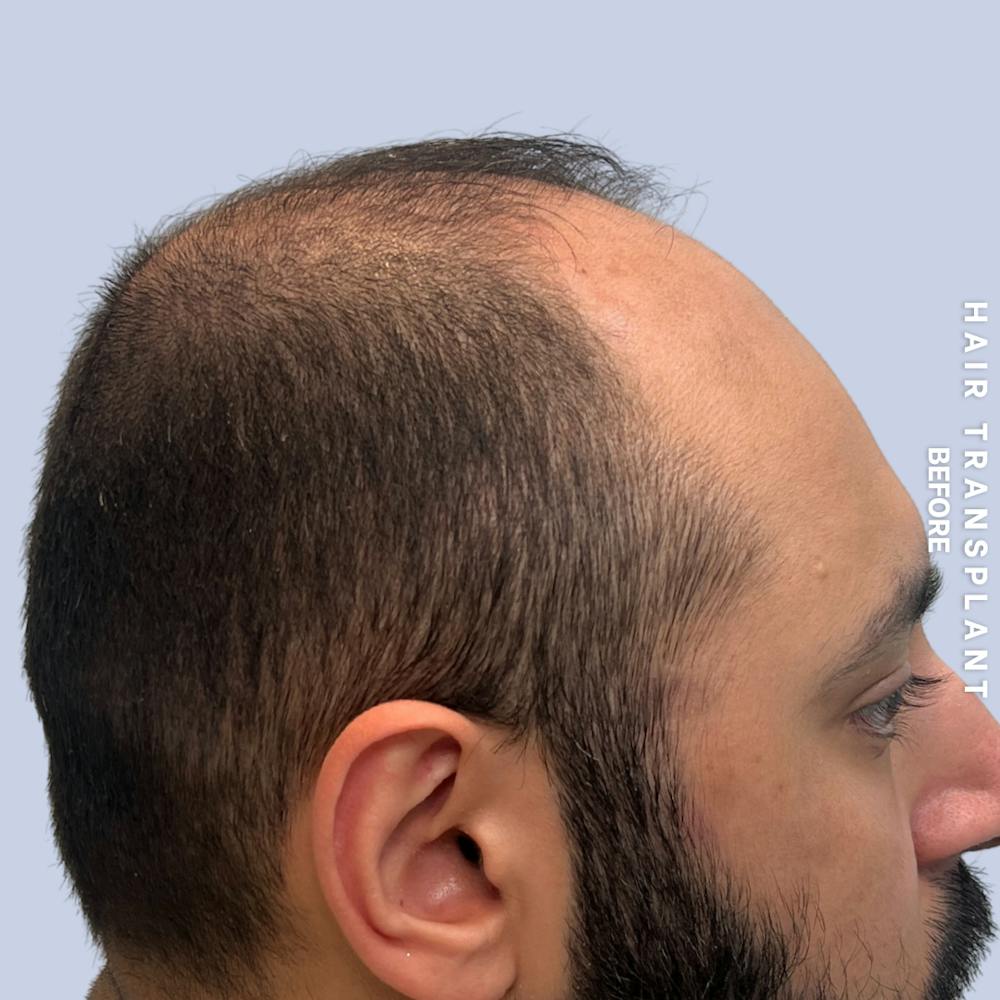 Hair Restoration Before & After Gallery - Patient 130289 - Image 7