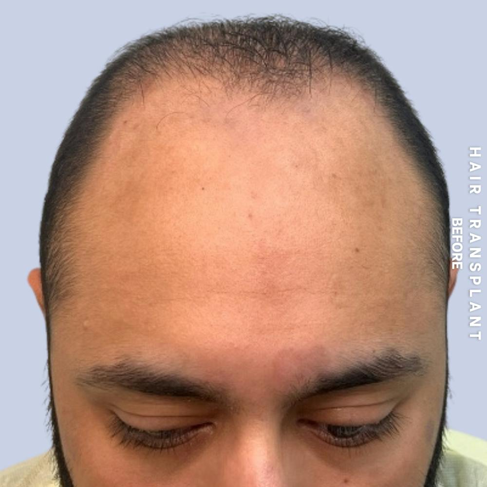 Hair Restoration Before & After Gallery - Patient 130289 - Image 3