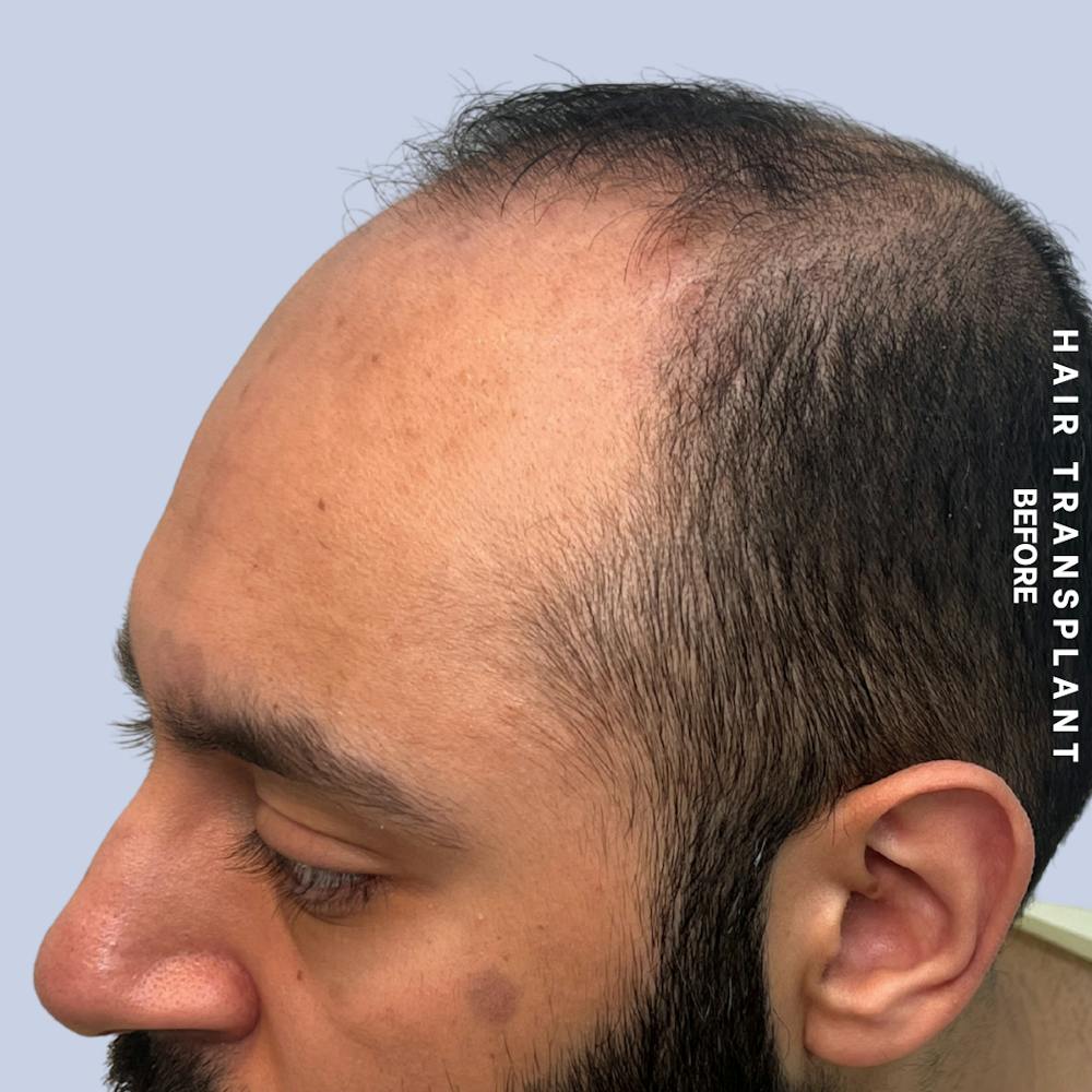 Hair Restoration Before & After Gallery - Patient 130289 - Image 9