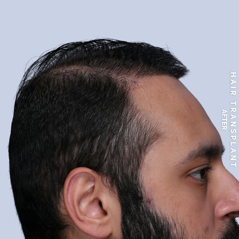 Hair Restoration Before & After Gallery - Patient 130289 - Image 8