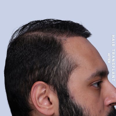 Hair Restoration Before & After Gallery - Patient 130289 - Image 8