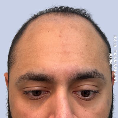 Hair Restoration Before & After Gallery - Patient 130289 - Image 1
