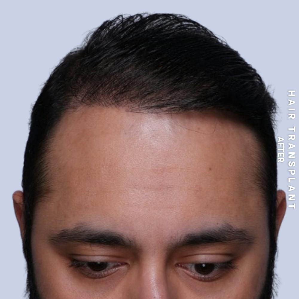 Hair Restoration Before & After Gallery - Patient 130289 - Image 4