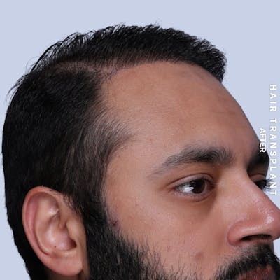Hair Restoration Before & After Gallery - Patient 130289 - Image 6