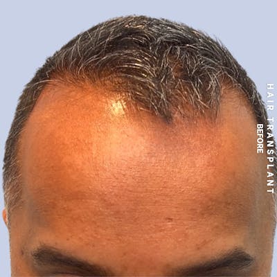 Hair Restoration Before & After Gallery - Patient 302067 - Image 1