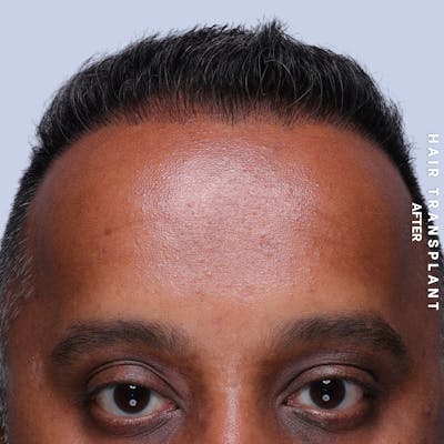 Hair Restoration Before & After Gallery - Patient 302067 - Image 2