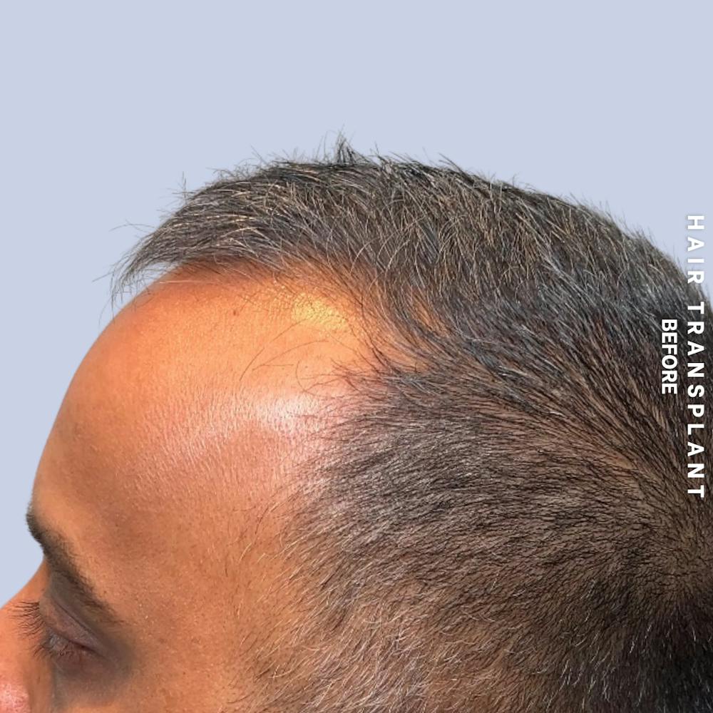 Hair Restoration Before & After Gallery - Patient 302067 - Image 5
