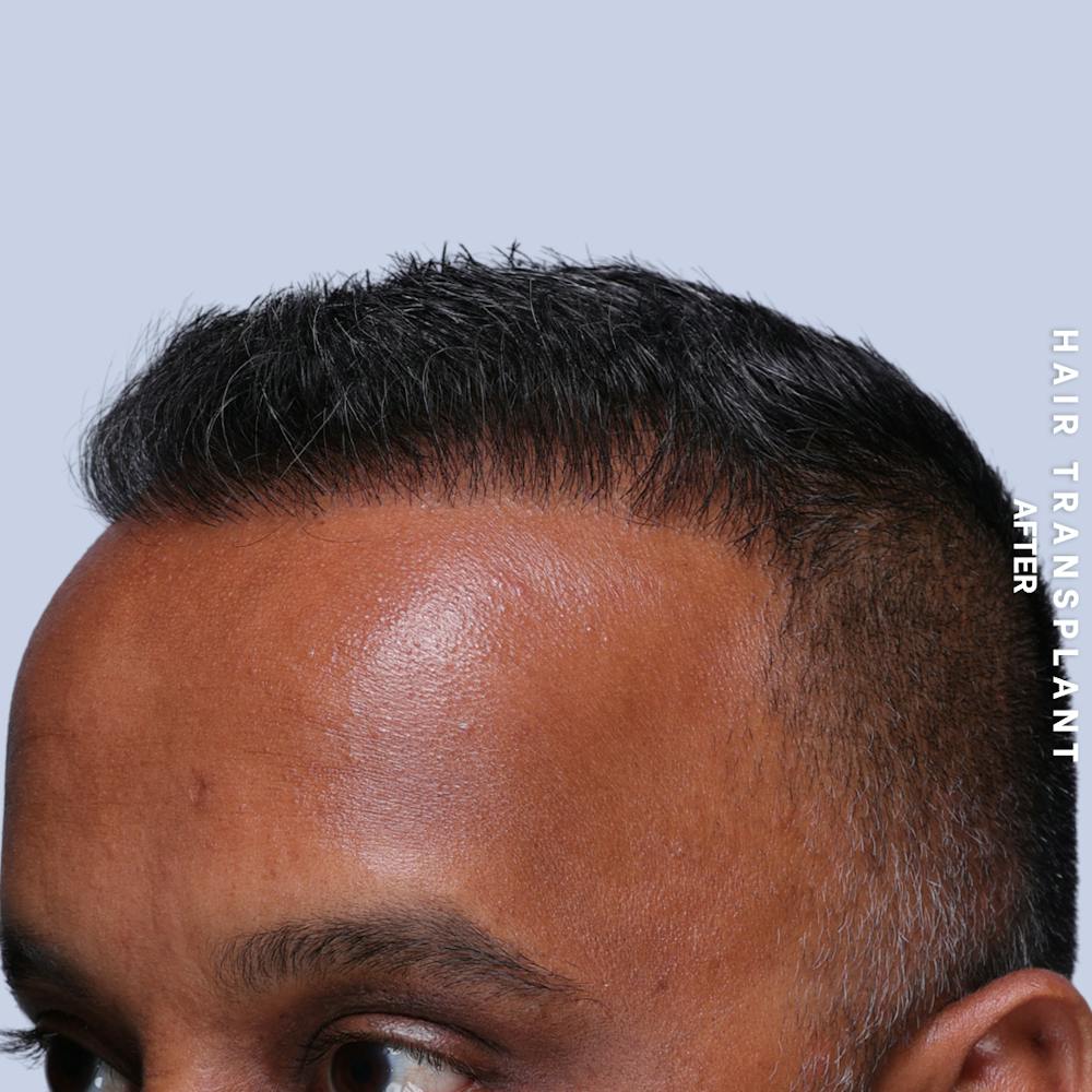 Hair Restoration Before & After Gallery - Patient 302067 - Image 6
