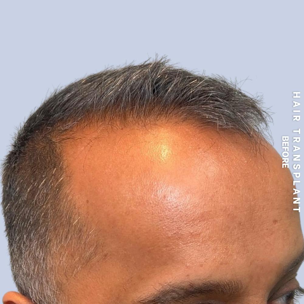 Hair Restoration Before & After Gallery - Patient 302067 - Image 3