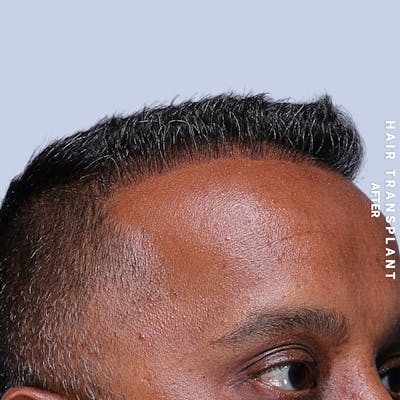 Hair Restoration Before & After Gallery - Patient 302067 - Image 4