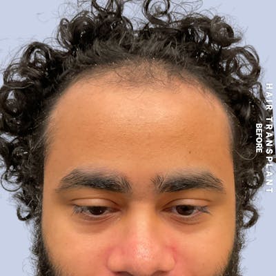 Hair Restoration Before & After Gallery - Patient 846363 - Image 1