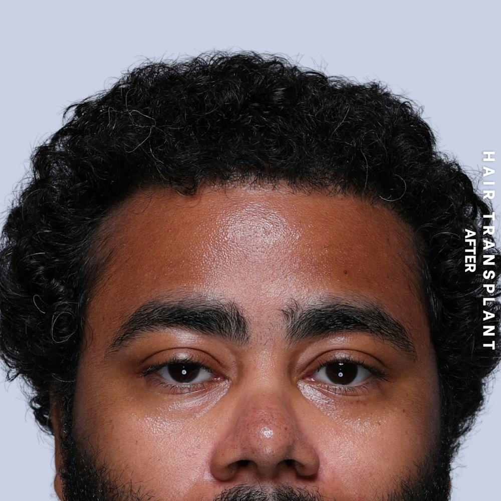 Hair Restoration Before & After Gallery - Patient 846363 - Image 2