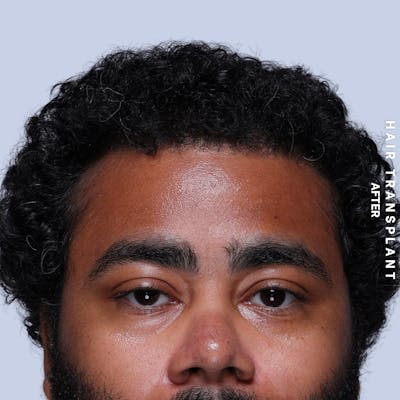 Hair Restoration Before & After Gallery - Patient 846363 - Image 2