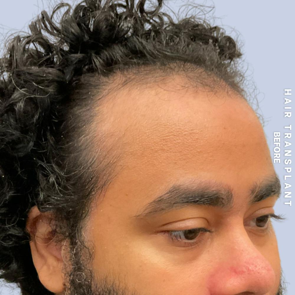 Hair Restoration Before & After Gallery - Patient 846363 - Image 5