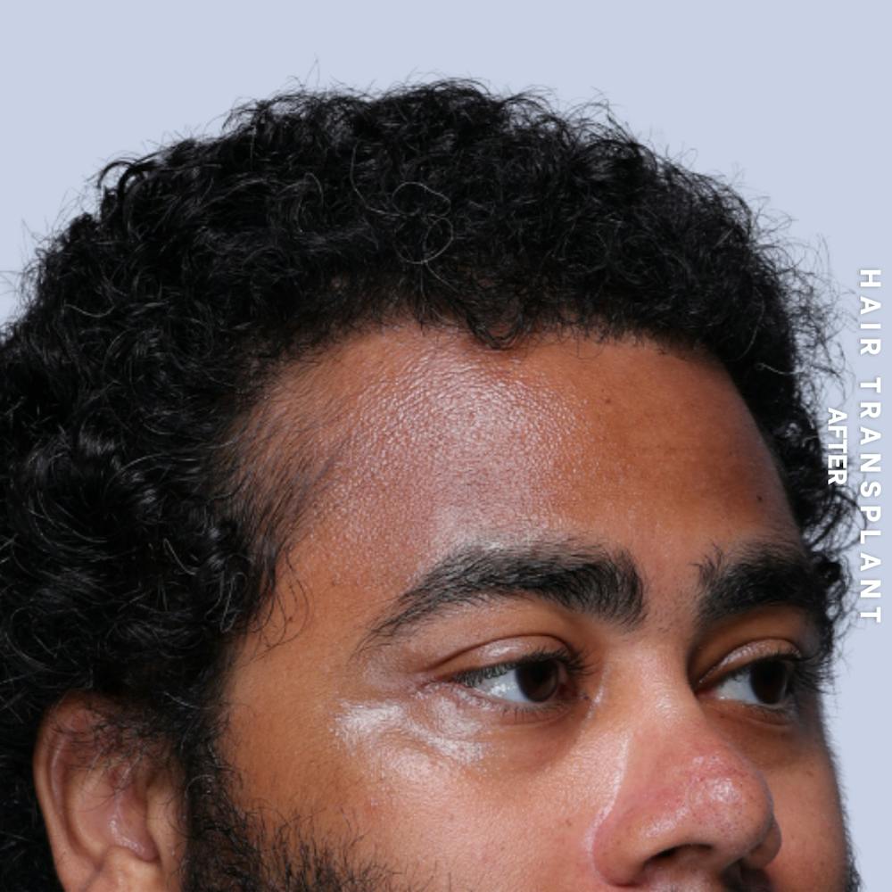 Hair Restoration Before & After Gallery - Patient 846363 - Image 6