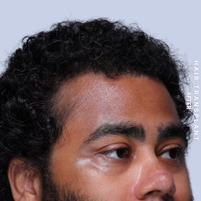 Hair Restoration Before & After Gallery - Patient 846363 - Image 6