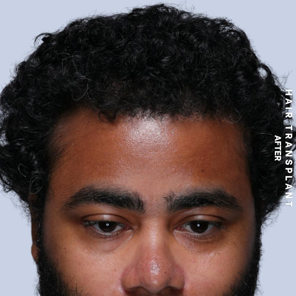 Hair Restoration Before & After Gallery - Patient 846363 - Image 8