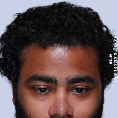 Hair Restoration Before & After Gallery - Patient 846363 - Image 8