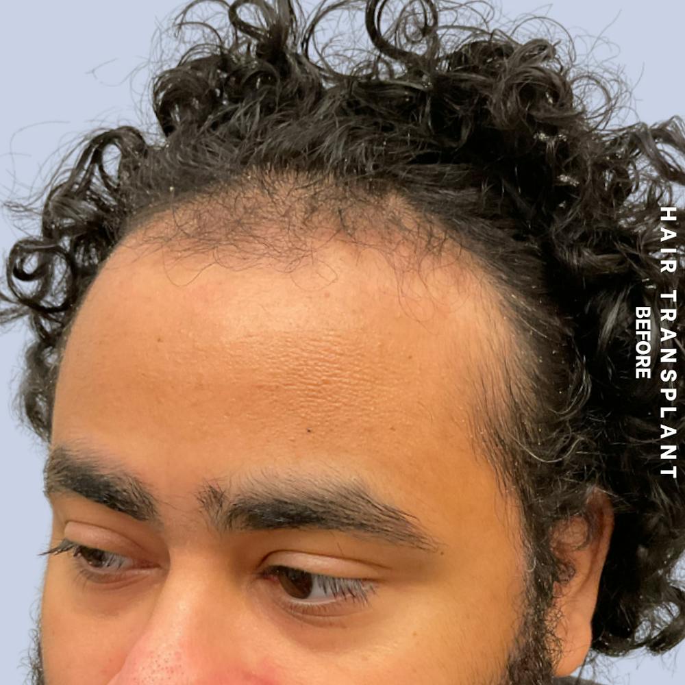 Hair Restoration Before & After Gallery - Patient 846363 - Image 3
