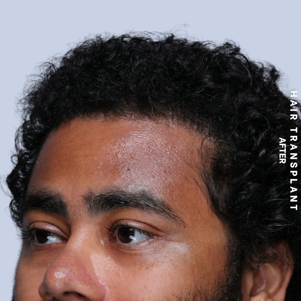 Hair Restoration Before & After Gallery - Patient 846363 - Image 4
