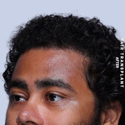 Hair Restoration Before & After Gallery - Patient 846363 - Image 4