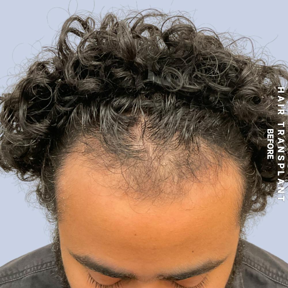 Hair Restoration Before & After Gallery - Patient 846363 - Image 7