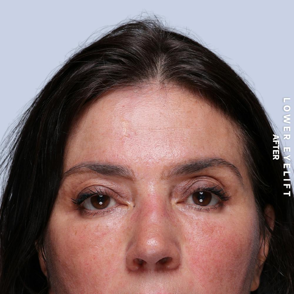 Eyes Before & After Gallery - Patient 143724 - Image 2
