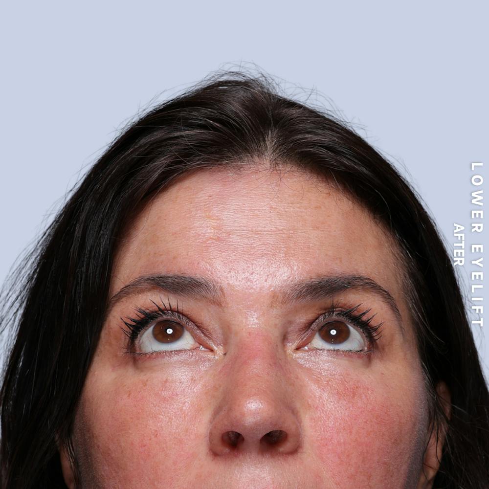 Eyes Before & After Gallery - Patient 143724 - Image 4