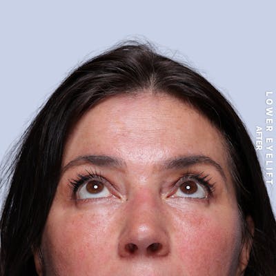 Eyes Before & After Gallery - Patient 143724 - Image 4
