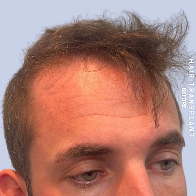Men's Hair Before & After Gallery - Patient 382607 - Image 1