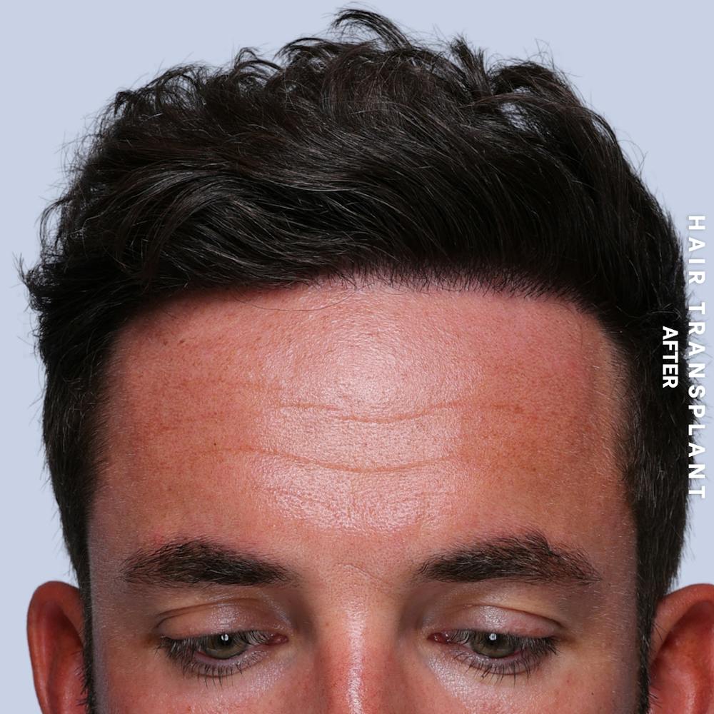 Men's Hair Before & After Gallery - Patient 382607 - Image 10