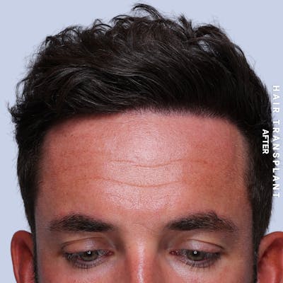 Men's Hair Before & After Gallery - Patient 382607 - Image 10