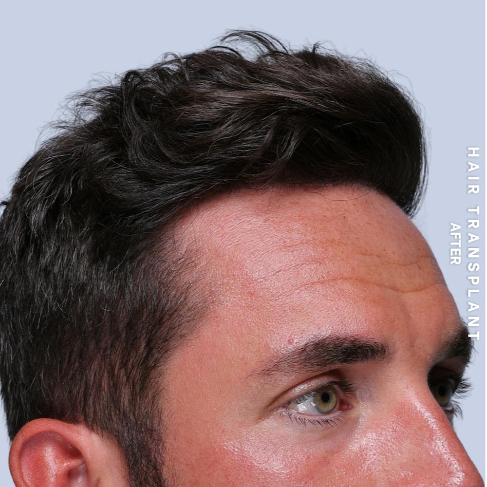 Men's Hair Before & After Gallery - Patient 382607 - Image 2