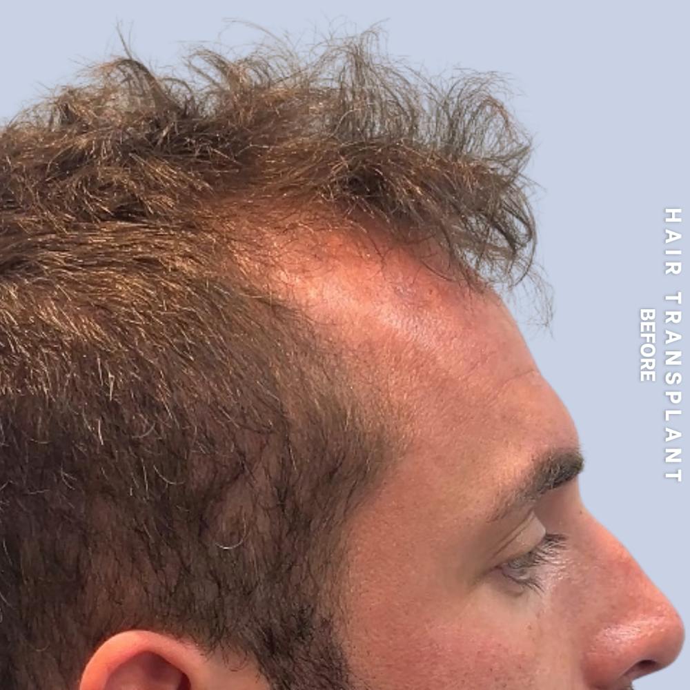 Men's Hair Before & After Gallery - Patient 382607 - Image 3
