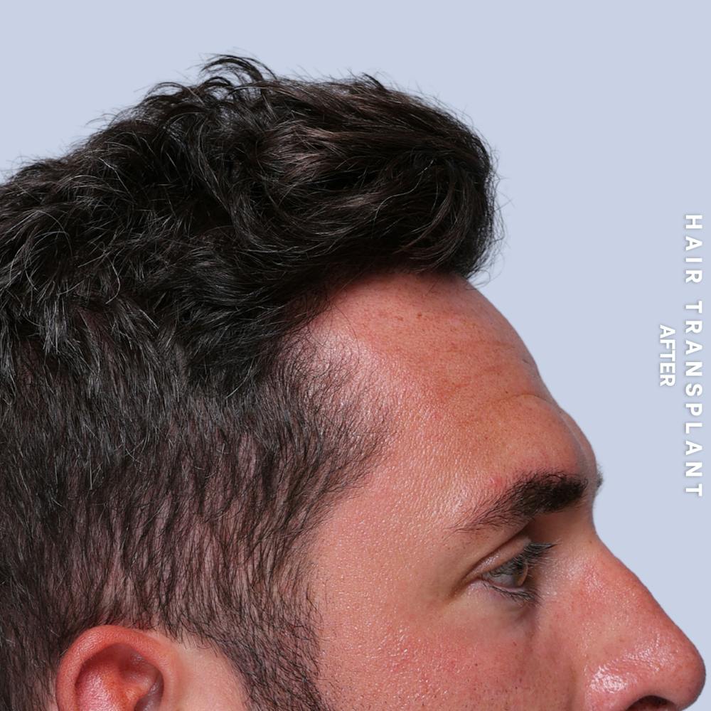 Men's Hair Before & After Gallery - Patient 382607 - Image 4