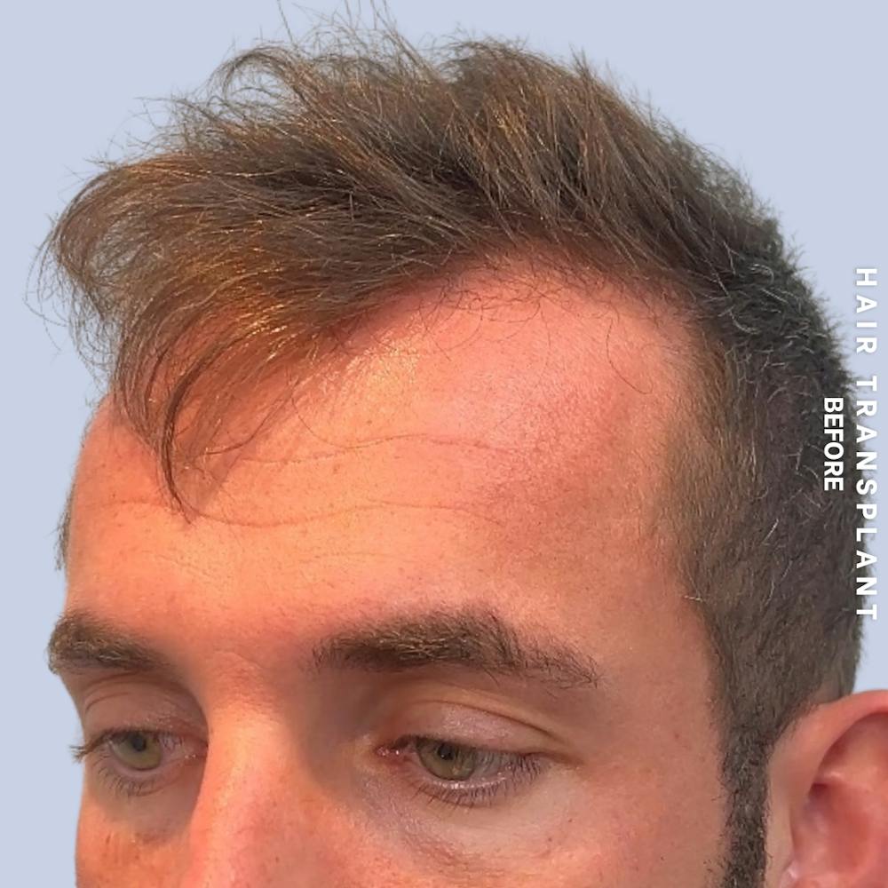 Men's Hair Before & After Gallery - Patient 382607 - Image 5