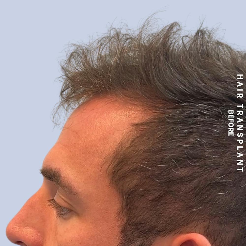 Men's Hair Before & After Gallery - Patient 382607 - Image 7