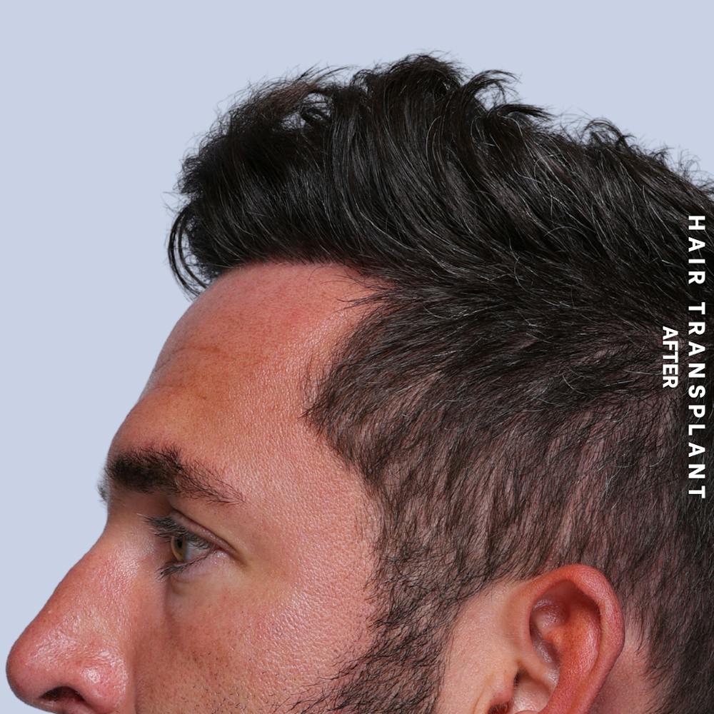 Men's Hair Before & After Gallery - Patient 382607 - Image 8