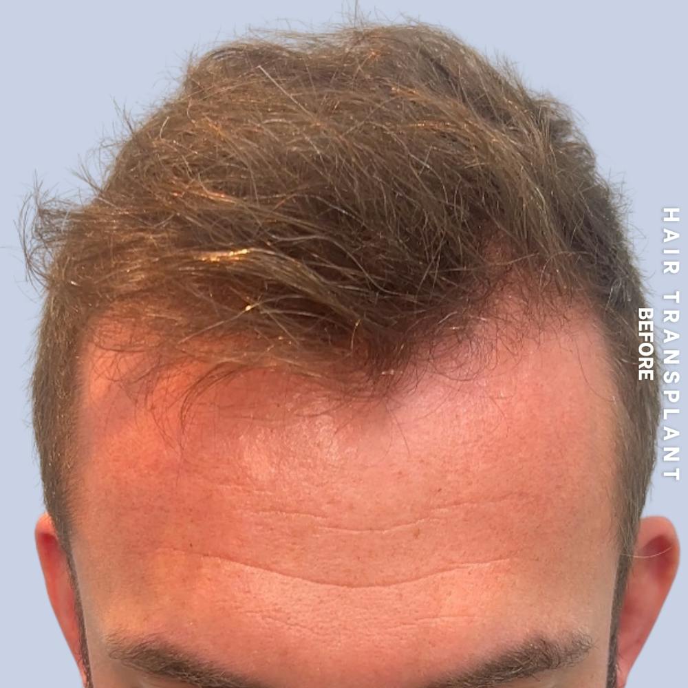 Men's Hair Before & After Gallery - Patient 382607 - Image 9
