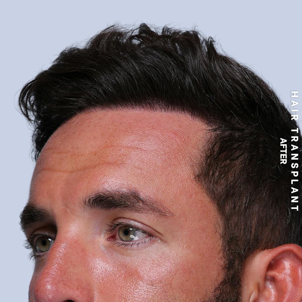 Men's Hair Before & After Gallery - Patient 382607 - Image 6
