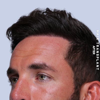 Men's Hair Before & After Gallery - Patient 382607 - Image 6