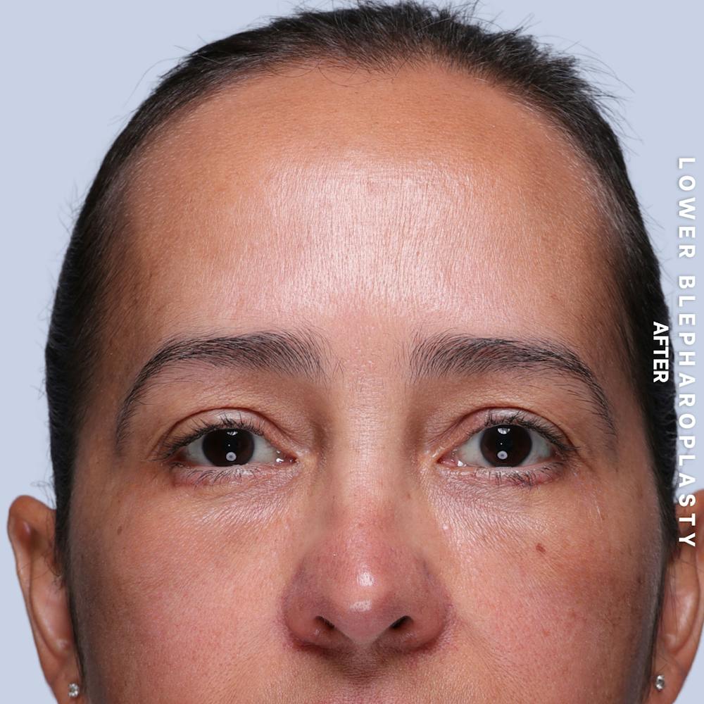 Eyes Before & After Gallery - Patient 318165 - Image 2