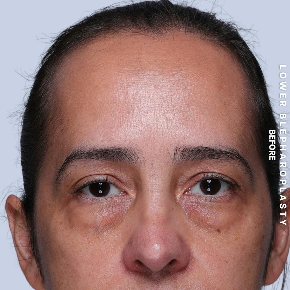 Eyes Before & After Gallery - Patient 318165 - Image 1