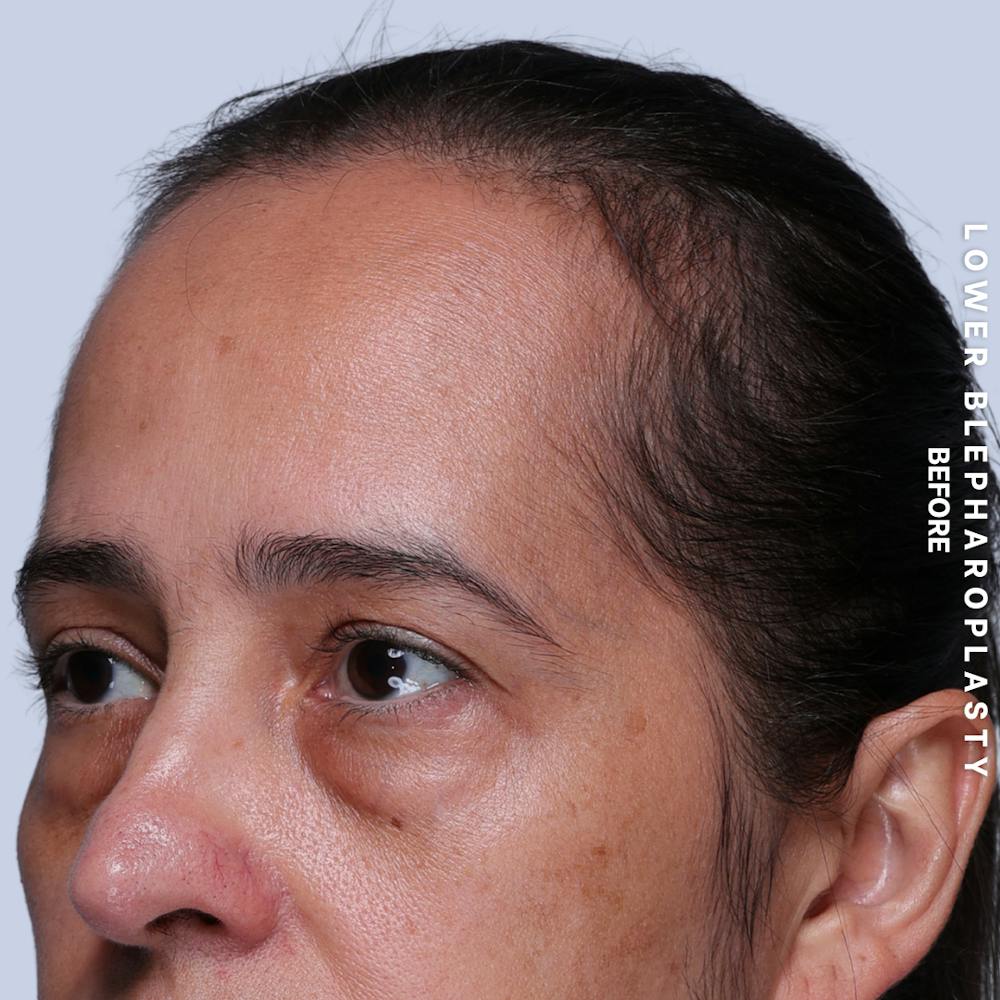 Eyes Before & After Gallery - Patient 318165 - Image 3