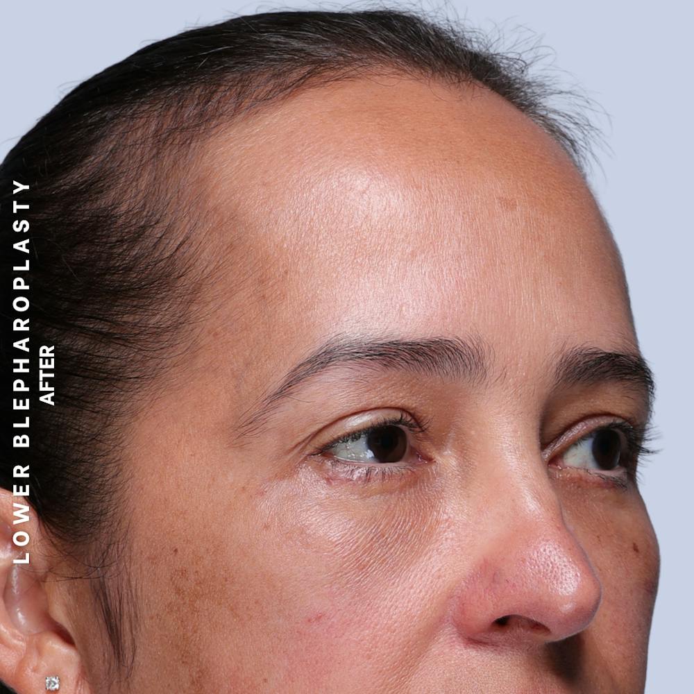 Eyes Before & After Gallery - Patient 318165 - Image 6