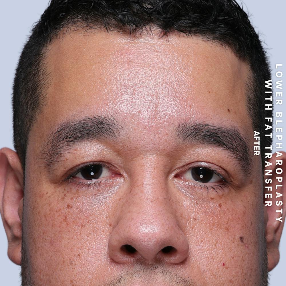 Eyes Before & After Gallery - Patient 117878 - Image 2