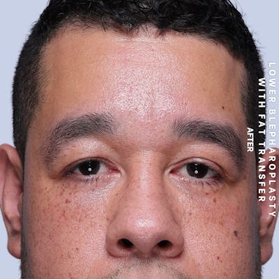Eyes Before & After Gallery - Patient 117878 - Image 2