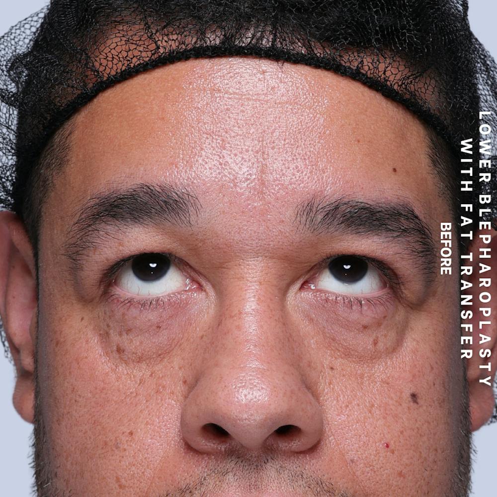 Eyes Before & After Gallery - Patient 117878 - Image 3