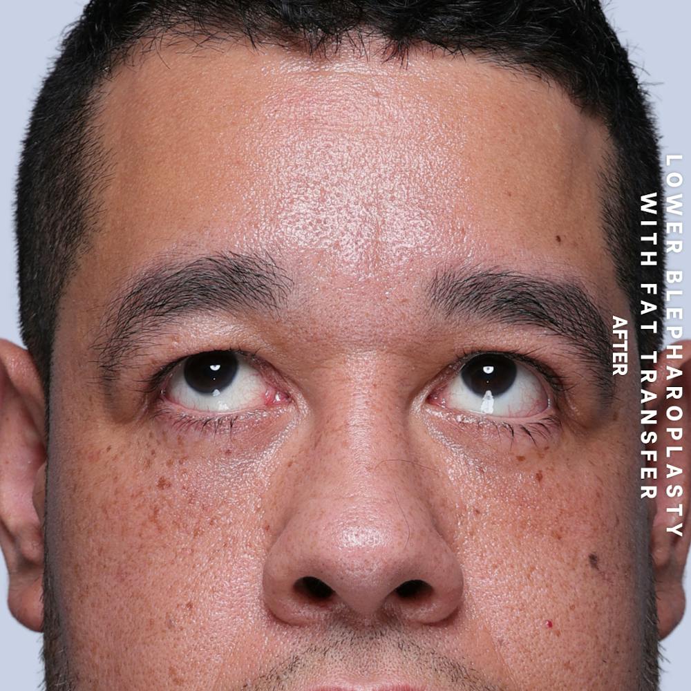 Eyes Before & After Gallery - Patient 117878 - Image 4